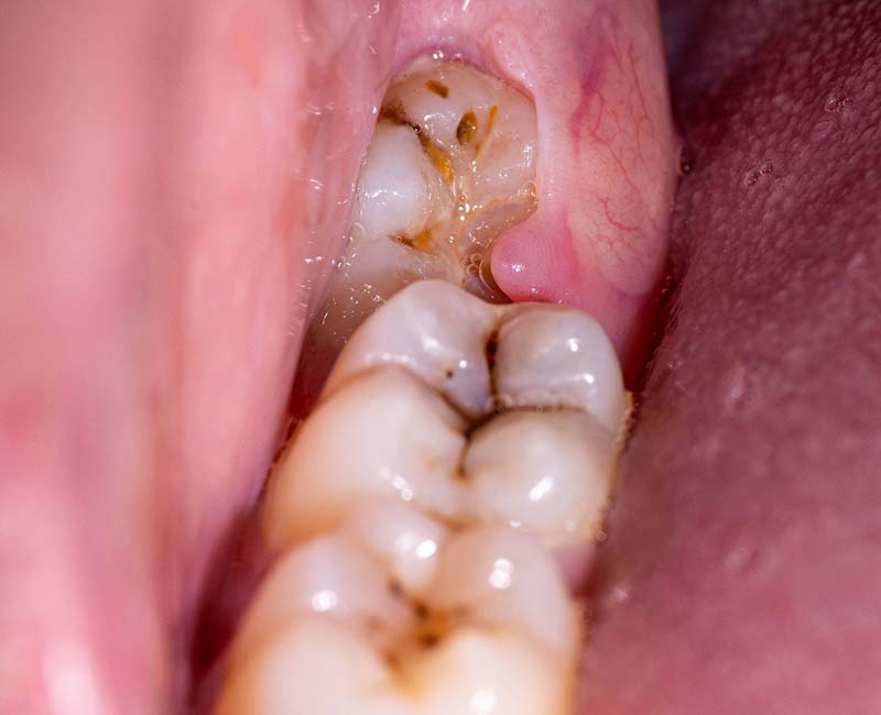 22296-impacted-wisdom-teeth Diagram showing an impacted wisdom tooth beneath the gum line