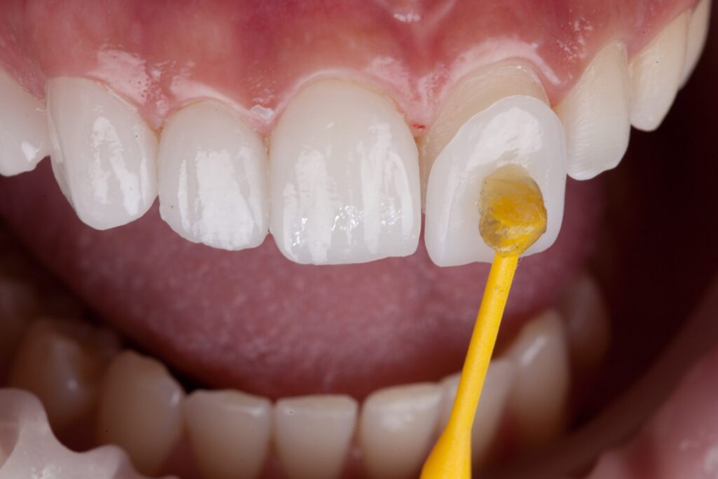 veneers, dental veneers, arbor dental, dentist, cosmetic
