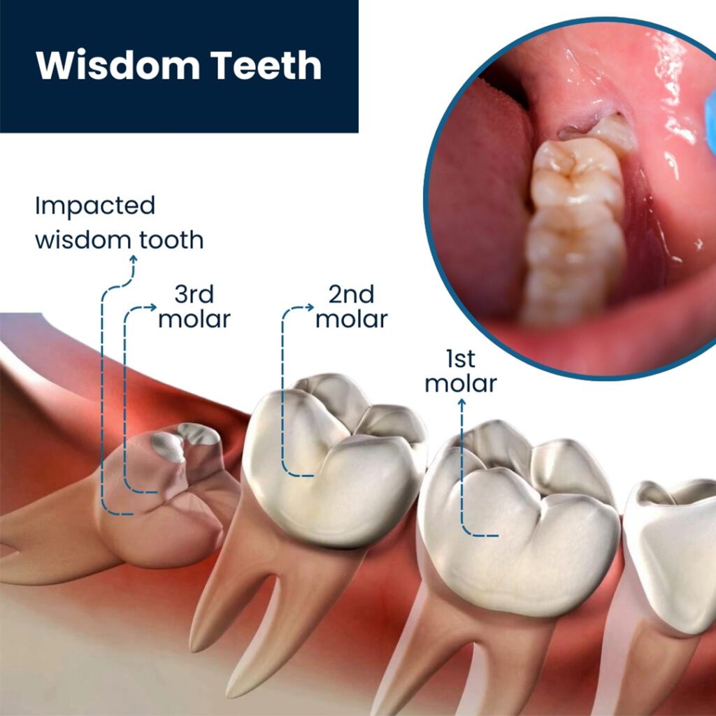 wisdom teeth, dentist, oral surgery, sedation, impacted, teenager