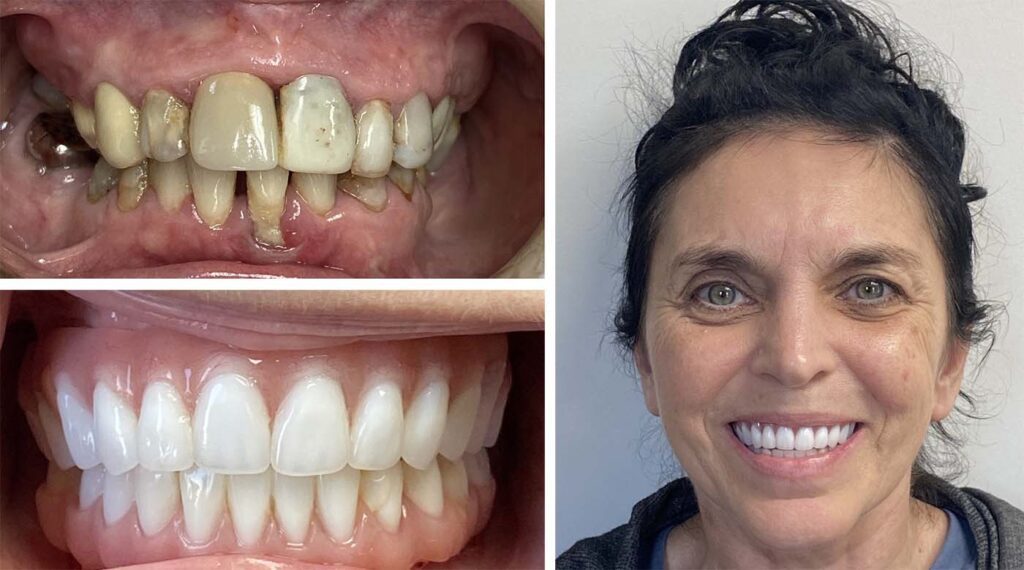 Full Arch Dental Implants: The Ultimate Solution for Missing Teeth