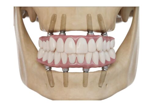 Helping People Smile Again: Dental Implants in Brentwood