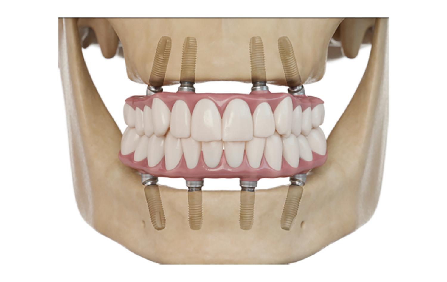 Helping People Smile Again: Dental Implants in Brentwood