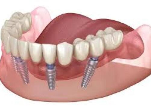 All-on-4, implants, brentwood, full arch, replacement teeth
