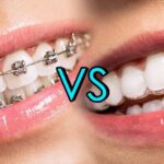 Brentwood Invisalign dentist for clear aligners
