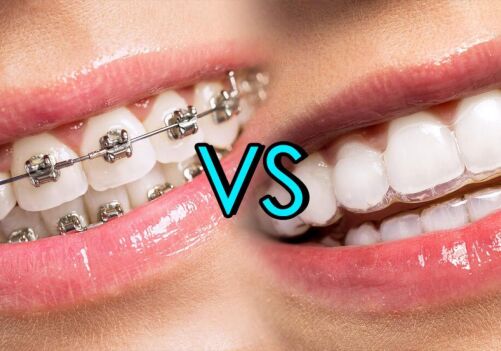 Brentwood Invisalign dentist for clear aligners