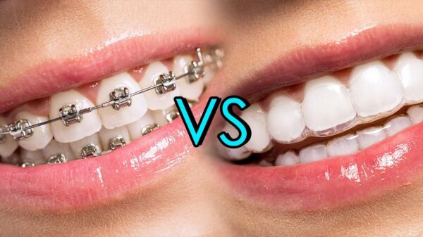 Brentwood Invisalign dentist for clear aligners