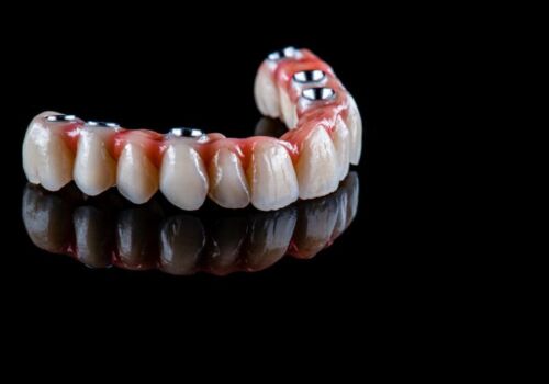Building Strong Foundations: All-on-4 Implants in Brentwood, Antioch, Oakley, Discovery Bay