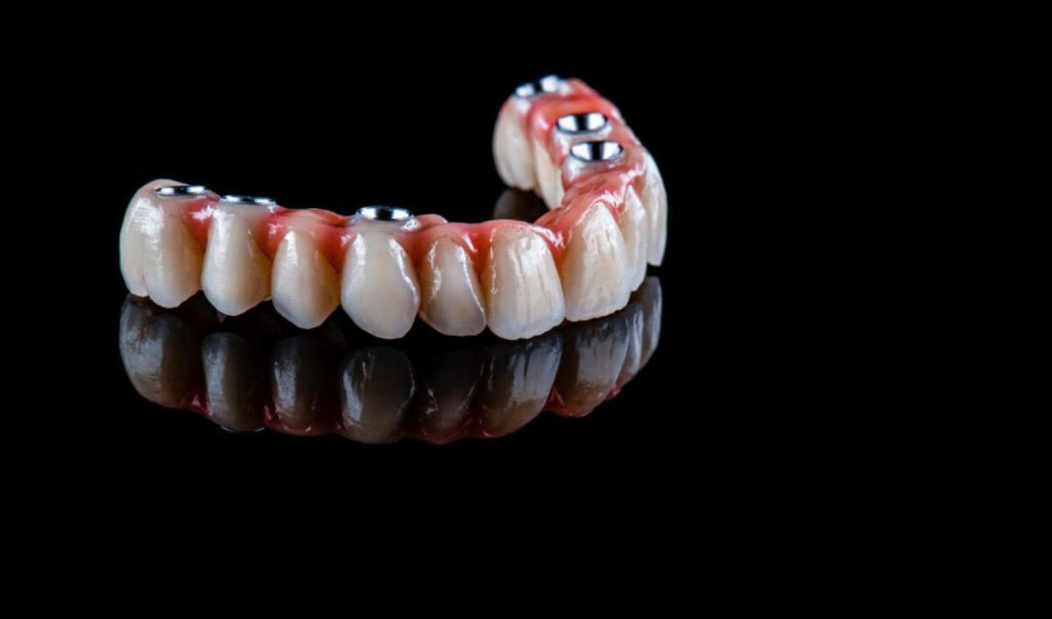 Building Strong Foundations: All-on-4 Implants in Brentwood, Antioch, Oakley, Discovery Bay