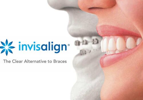 The Invisalign Experience: Creating Smiles at Arbor Dental in Brentwood