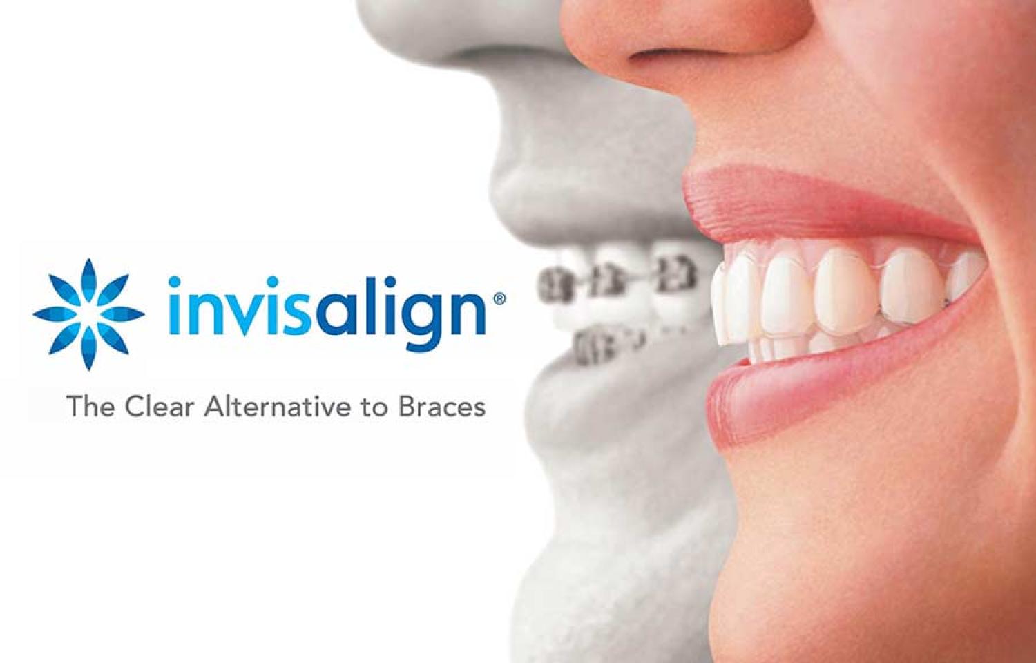 The Invisalign Experience: Creating Smiles at Arbor Dental in Brentwood