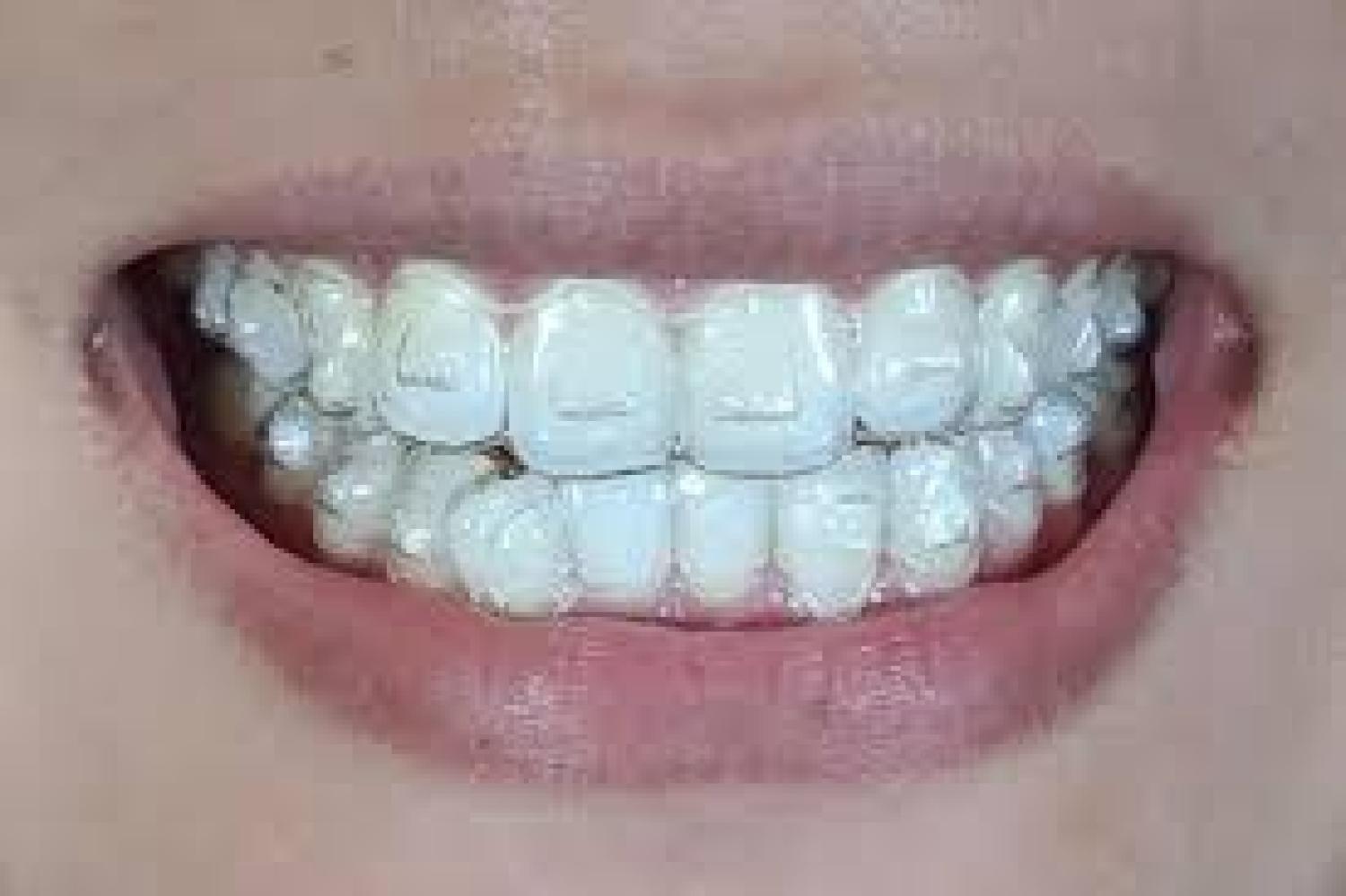 The Invisalign Experience: Creating Smiles at Arbor Dental in Brentwood