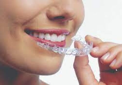 The Invisalign Experience: Creating Smiles at Arbor Dental in Brentwood