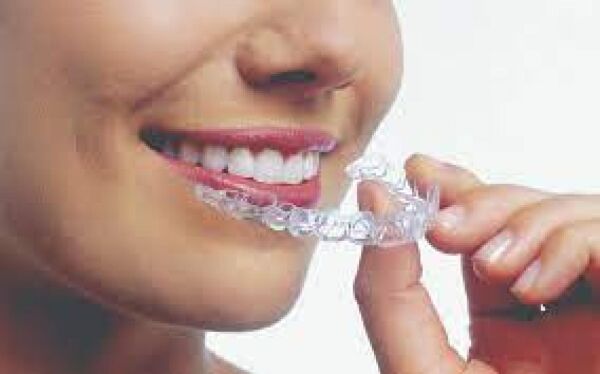 The Invisalign Experience: Creating Smiles at Arbor Dental in Brentwood