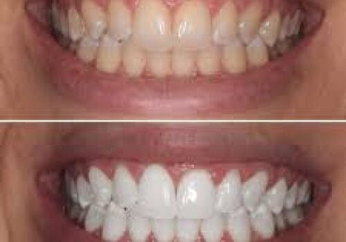 The Secrets to a Brighter Smile for Patients in Brentwood, Antioch, Oakley and Discovery Bay