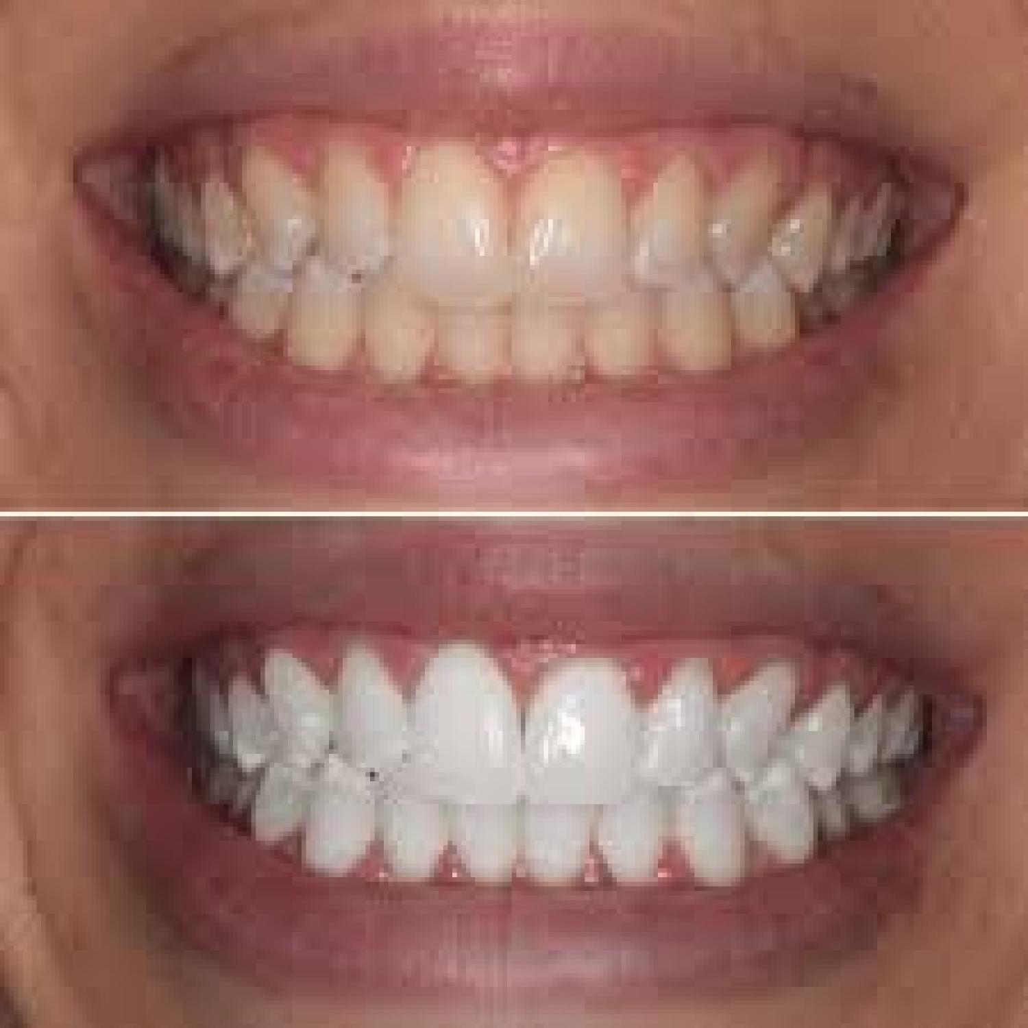 The Secrets to a Brighter Smile for Patients in Brentwood, Antioch, Oakley and Discovery Bay