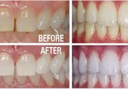 The Secrets to a Brighter Smile for Patients in Brentwood, Antioch, Oakley and Discovery Bay