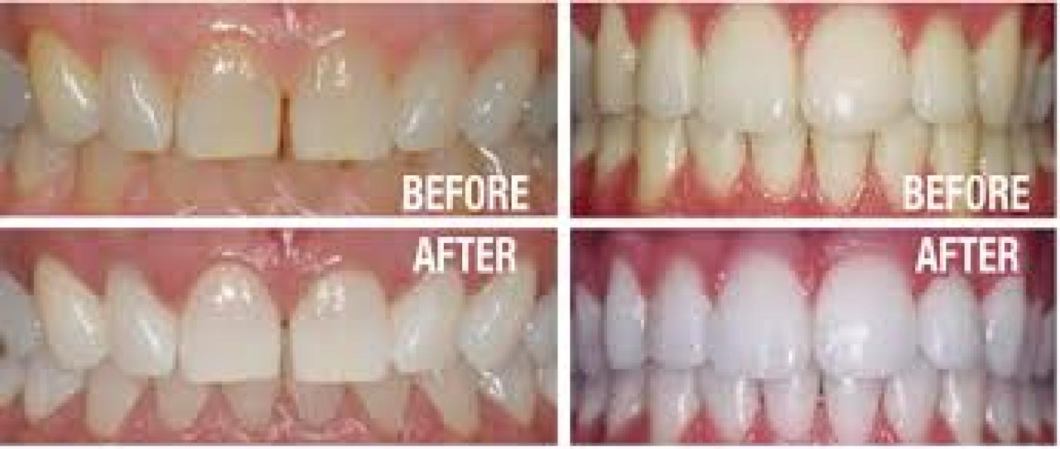The Secrets to a Brighter Smile for Patients in Brentwood, Antioch, Oakley and Discovery Bay