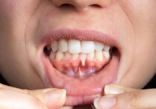 Treating Gum Disease: Dr. Ton’s Work in the Community