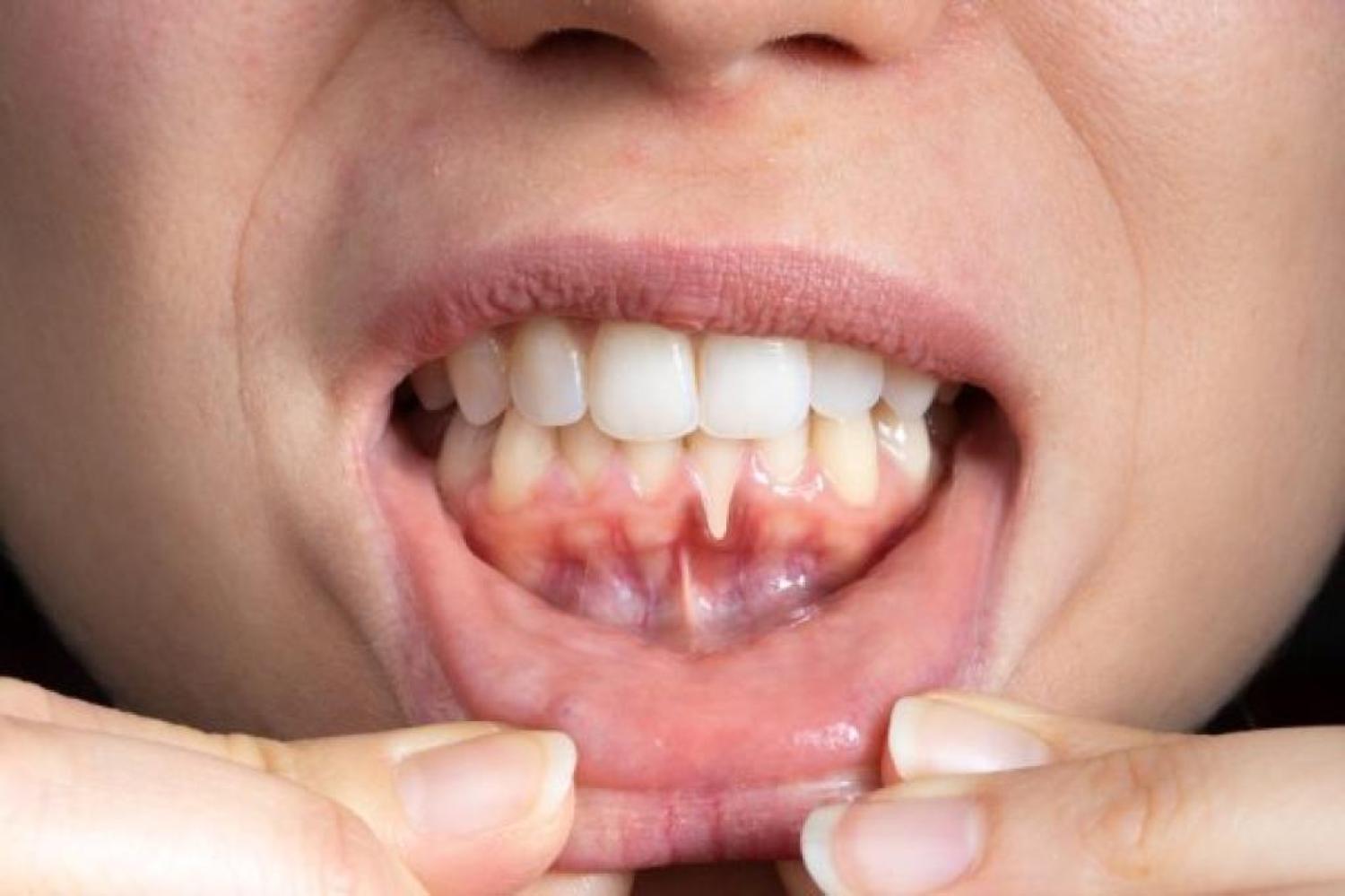 Treating Gum Disease: Dr. Ton’s Work in the Community