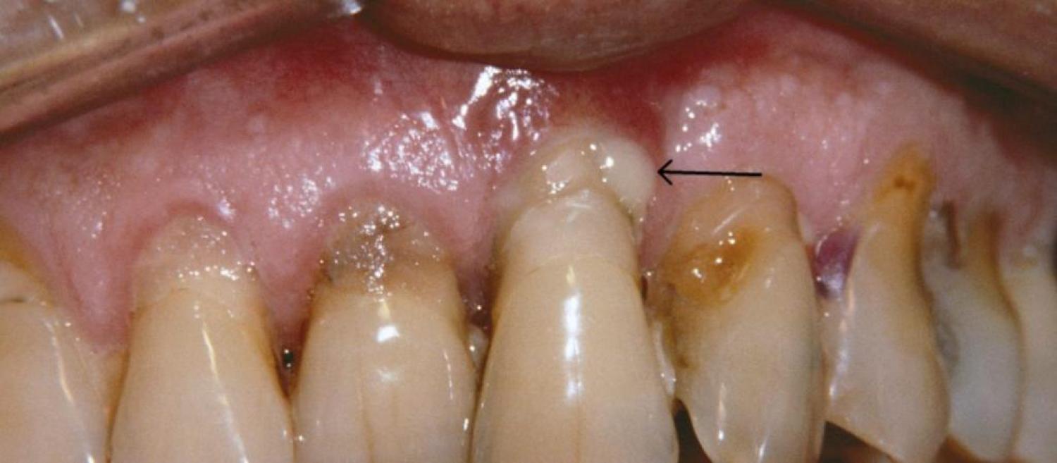 Treating Gum Disease: Dr. Ton’s Work in the Community