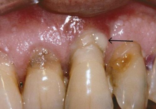 Treating Gum Disease: Dr. Ton’s Work in the Community