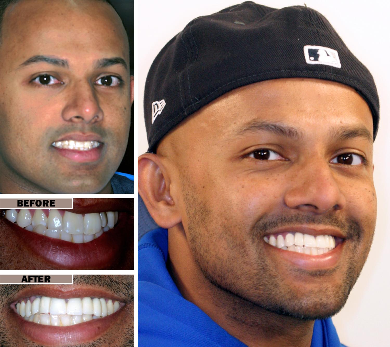 Veneers: The Secret to a Perfect Smile in Brentwood