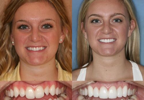 Veneers: The Secret to a Perfect Smile in Brentwood