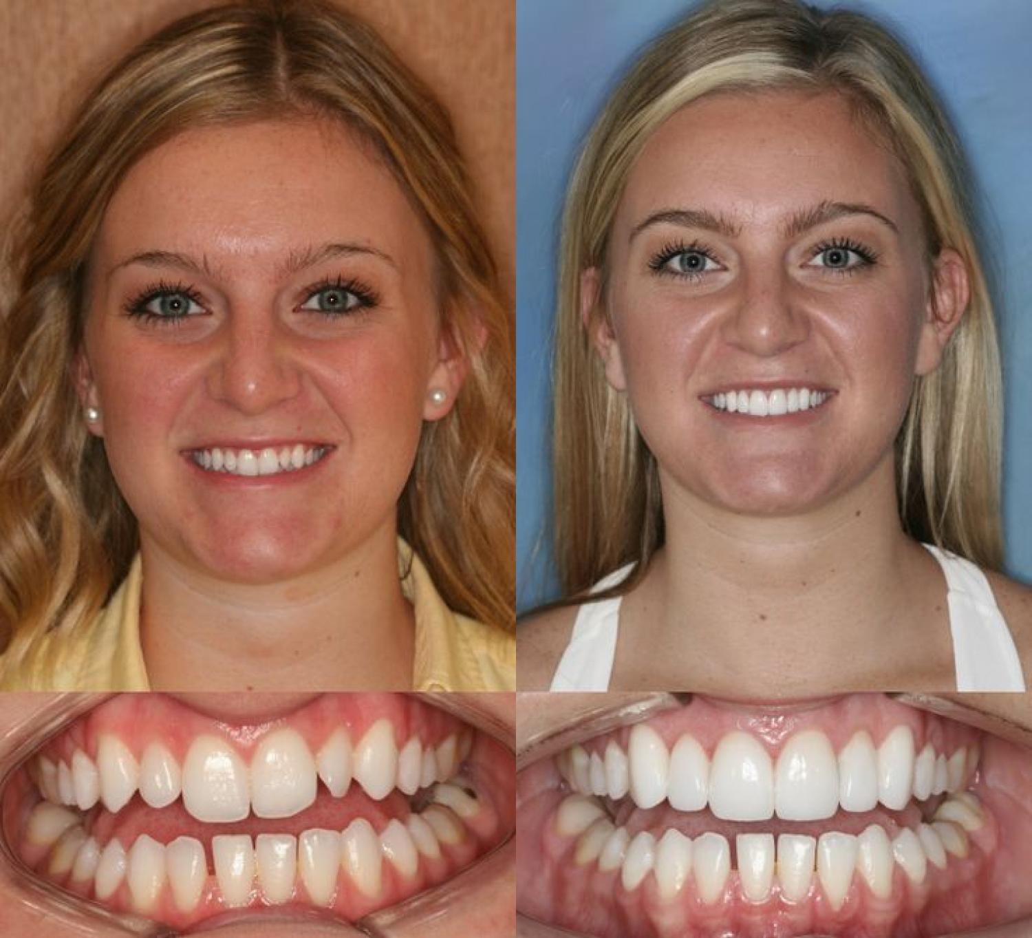 Veneers: The Secret to a Perfect Smile in Brentwood
