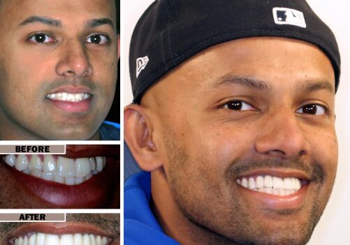 Veneers: The Secret to a Perfect Smile in Brentwood