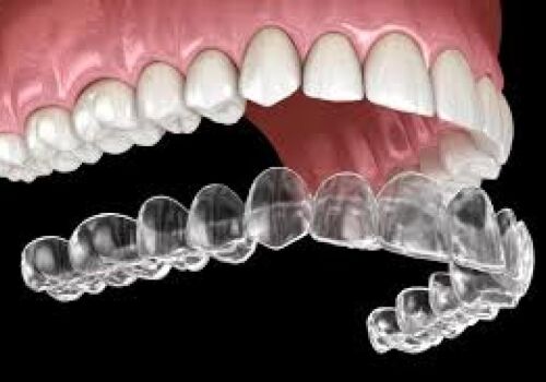The Invisalign Experience: Creating Smiles at Arbor Dental in Brentwood