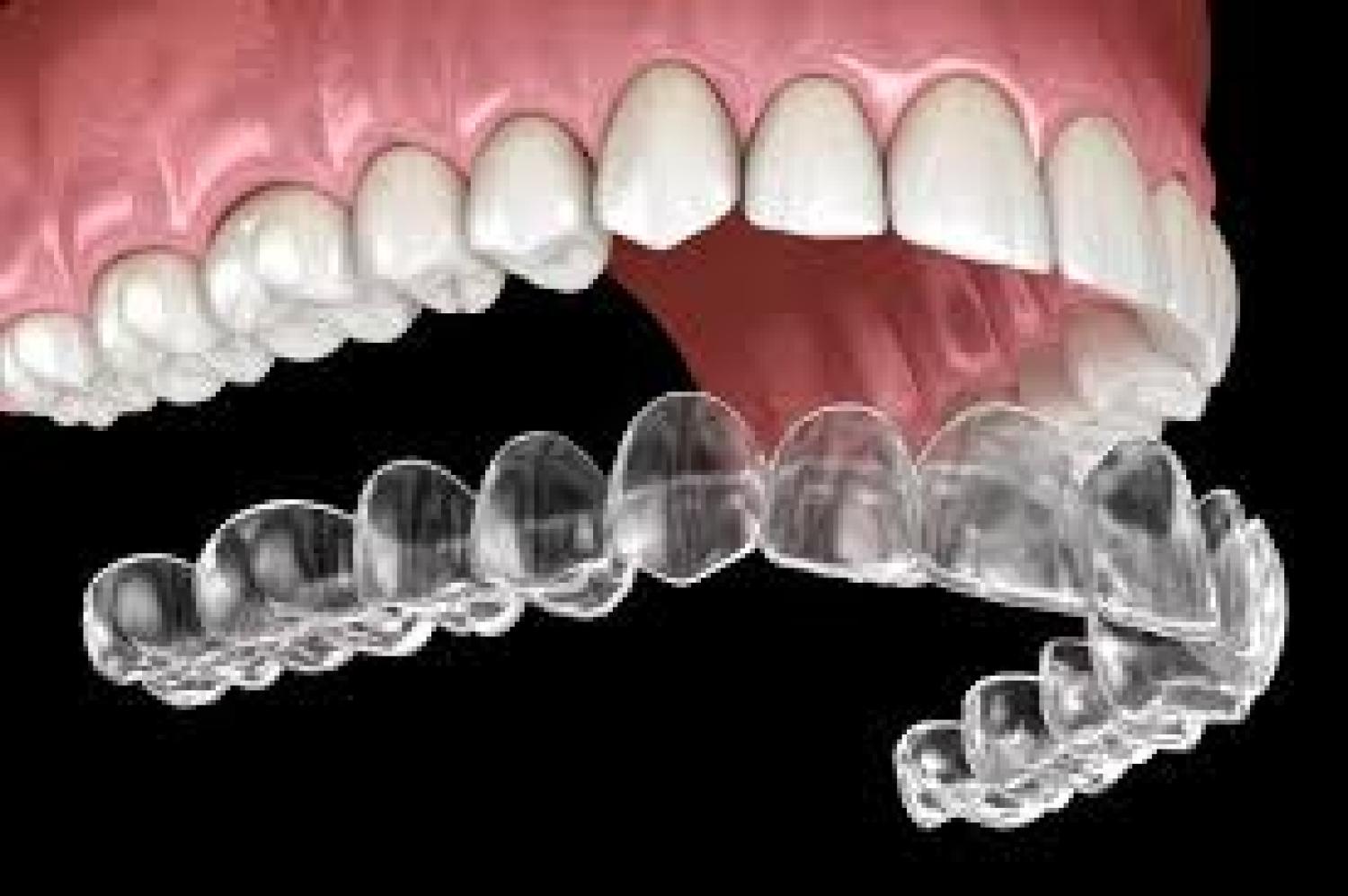 The Invisalign Experience: Creating Smiles at Arbor Dental in Brentwood