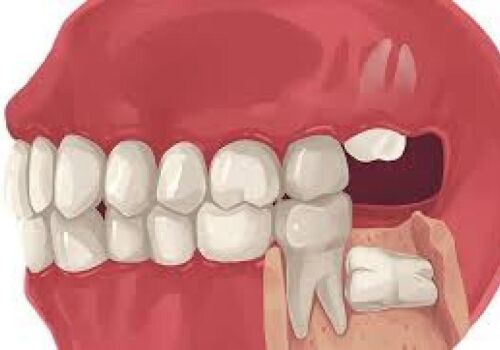 Solving Toothaches: Same-Day Tooth Extraction