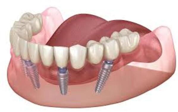 Building Strong Foundations: All-on-4 Implants in Brentwood, Antioch, Oakley, Discovery Bay