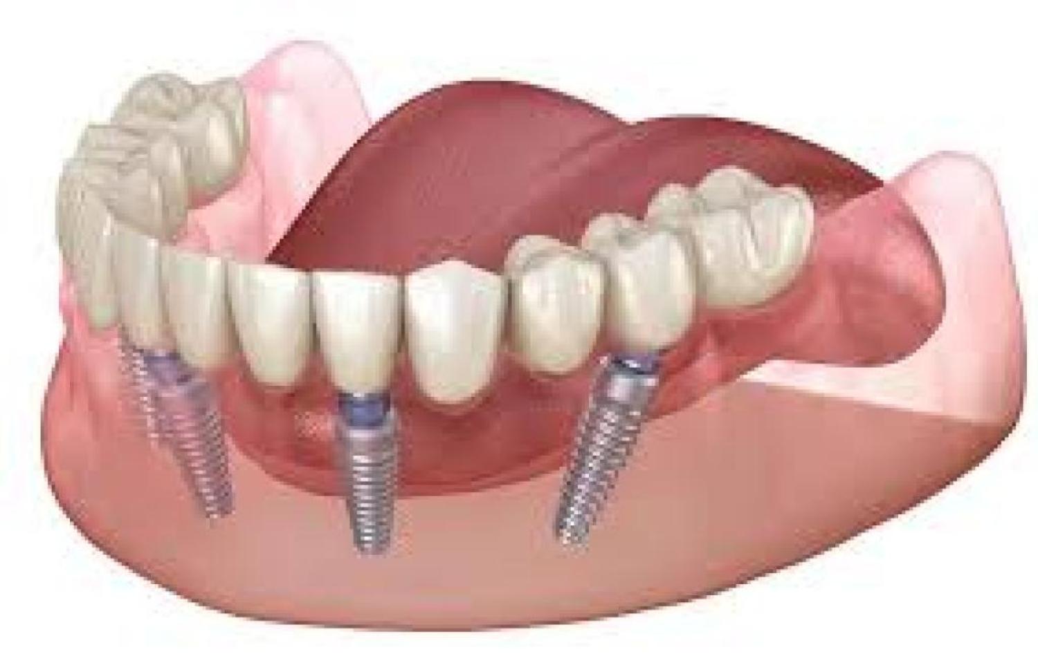 Dentist Extraction Dental Implants Building Strong Foundations: All-on-4 Implants in Brentwood, Antioch, Oakley, Discovery Bay