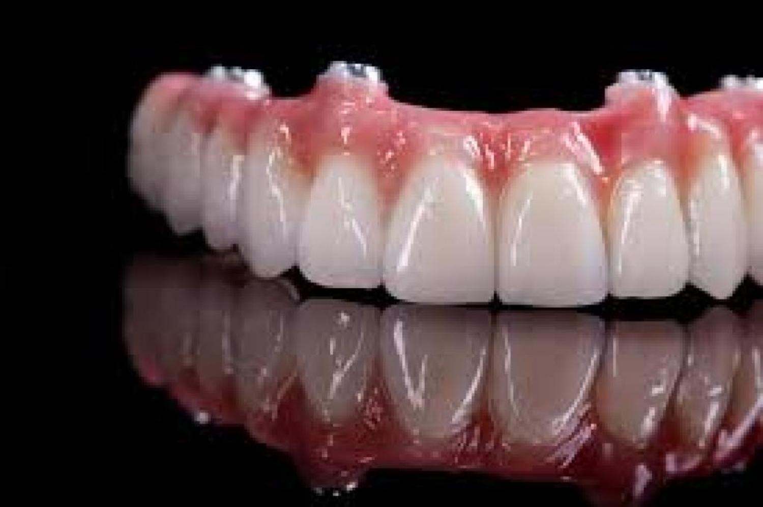 Building Strong Foundations: All-on-4 Implants in Brentwood, Antioch, Oakley, Discovery Bay