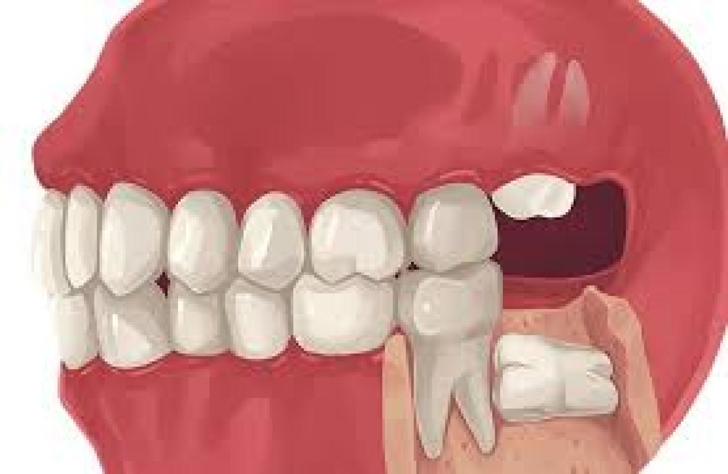 Solving Toothaches: Same-Day Tooth Extraction