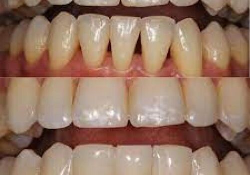 Dr. Ton, Arbor Dental, Brentwood, Extractions, Implants, Dentures