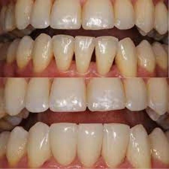 Dr. Ton, Arbor Dental, Brentwood, Extractions, Implants, Dentures