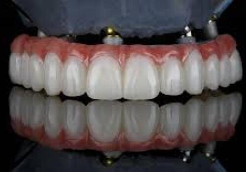 Building Strong Foundations: All-on-4 Implants in Brentwood, Antioch, Oakley, Discovery Bay