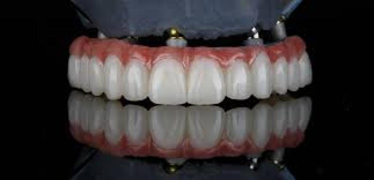 Building Strong Foundations: All-on-4 Implants in Brentwood, Antioch, Oakley, Discovery Bay