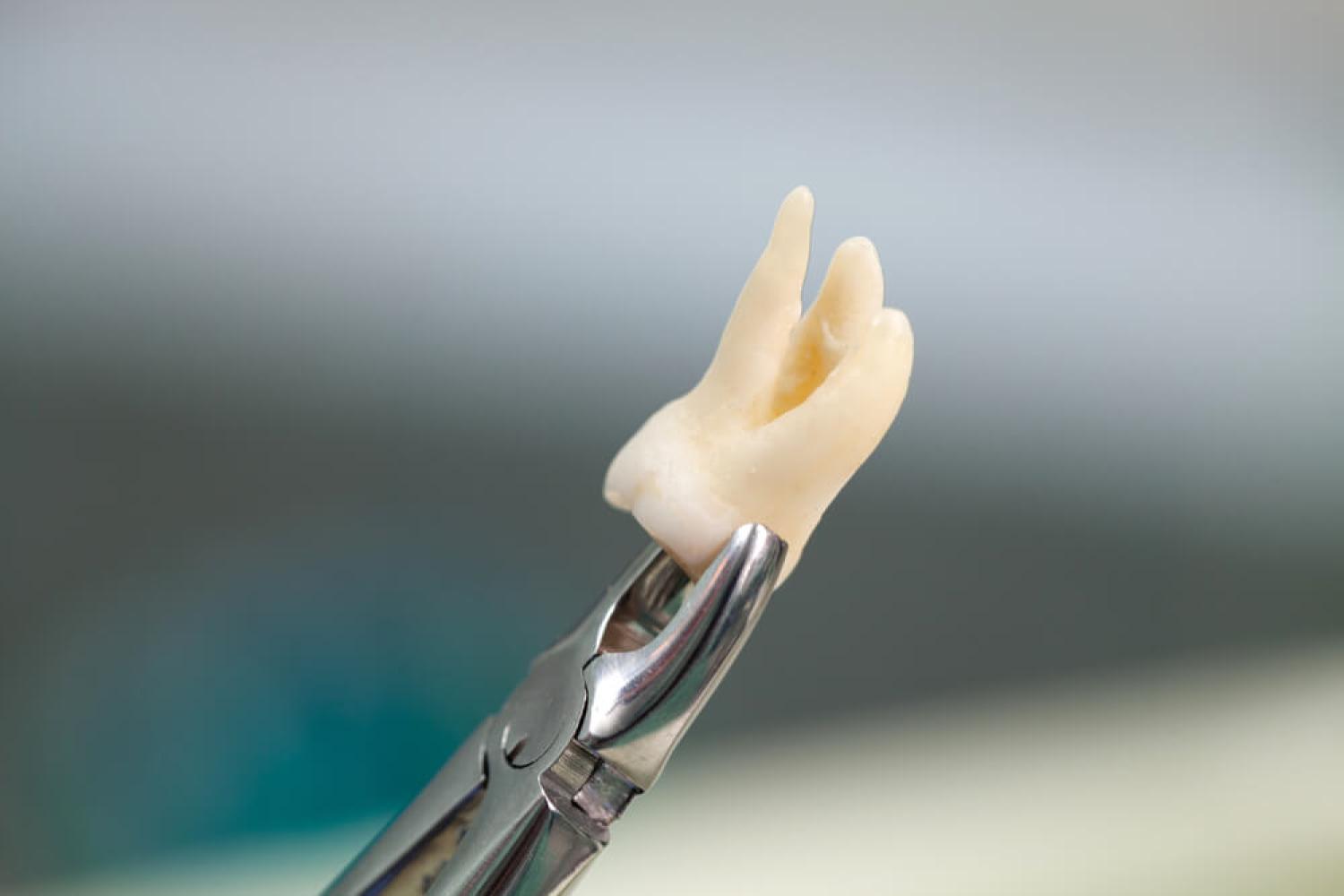 Solving Toothaches: Same-Day Tooth Extraction