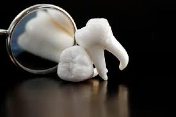 Wisdom Teeth, Brentwood Dentist, Dr. Ton, Teenagers