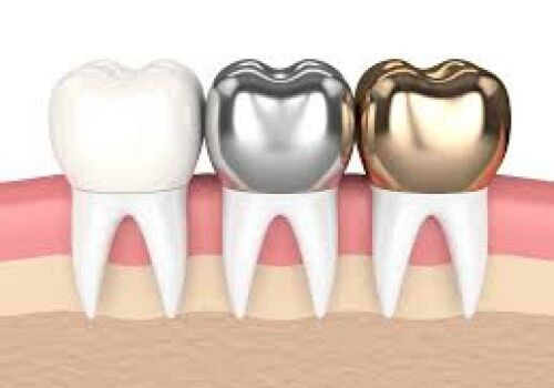 Saving Damaged Teeth: 5 Benefits of Dental Crowns