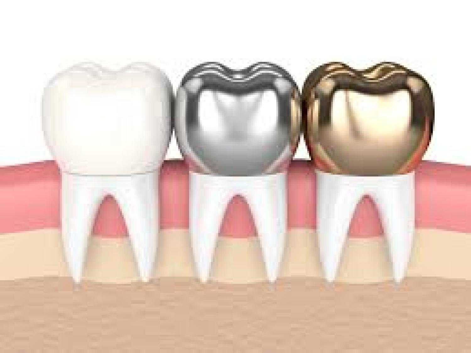 Saving Damaged Teeth: 5 Benefits of Dental Crowns