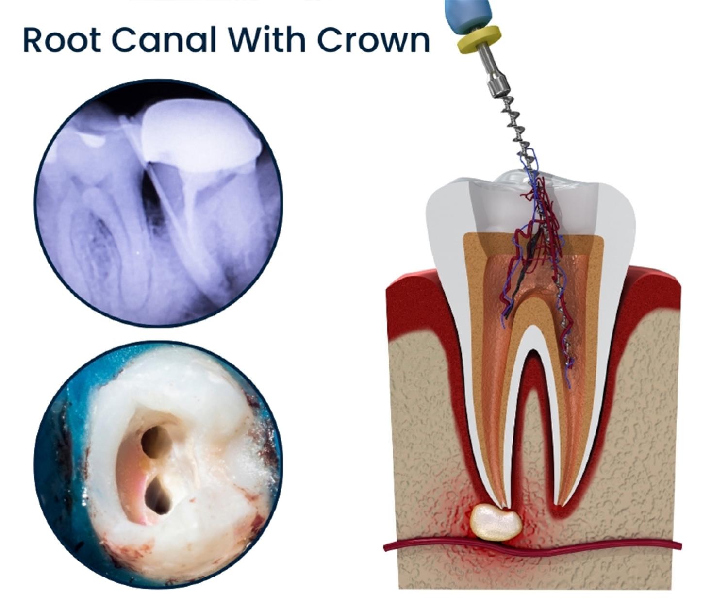 Dr. Ton's Expert Touch: Root Canal Treatment Explained
