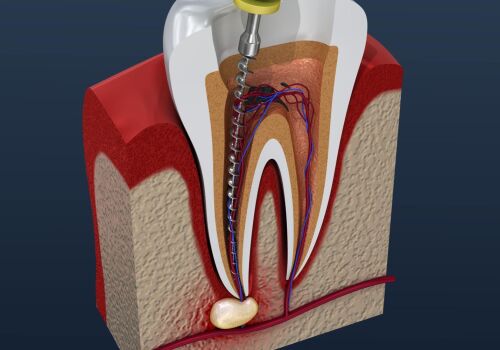 Dr. Ton's Expert Touch: Root Canal Treatment Explained