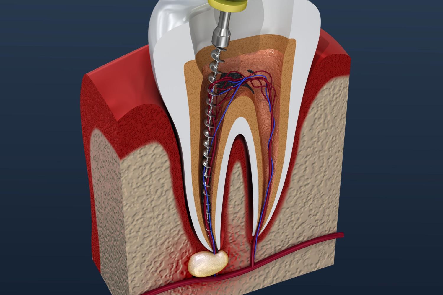 Dr. Ton's Expert Touch: Root Canal Treatment Explained