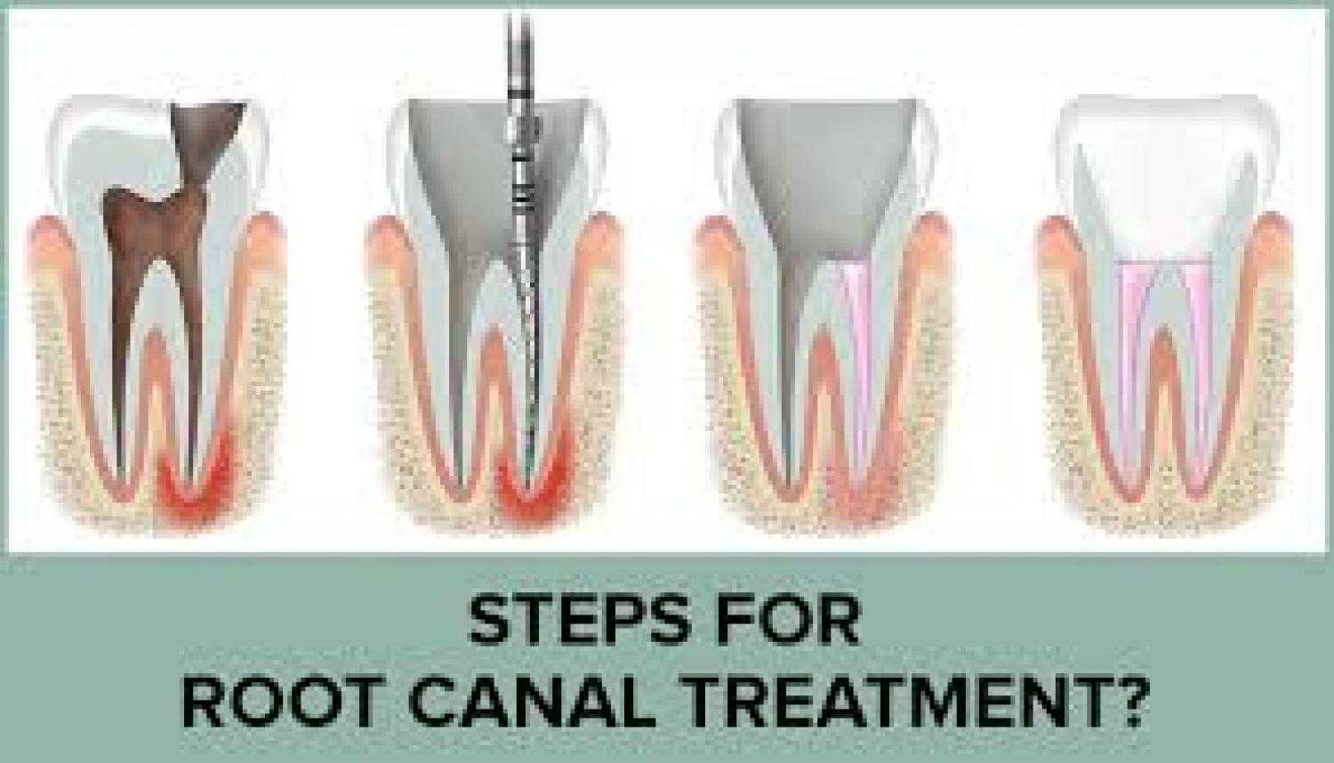 Dr. Ton's Expert Touch: Root Canal Treatment Explained