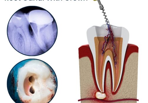 Dr. Ton's Expert Touch: Root Canal Treatment Explained