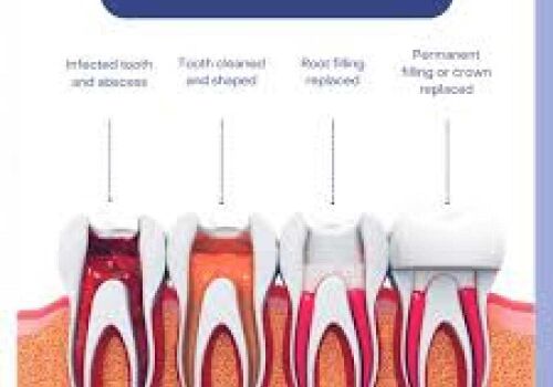 Dr. Ton's Expert Touch: Root Canal Treatment Explained